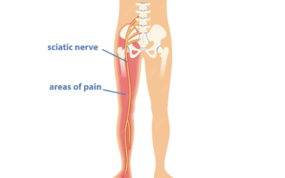 Jak rozpoznać pierwsze sygnały rwy kulszowej i działać, zanim pojawi się ostry ból